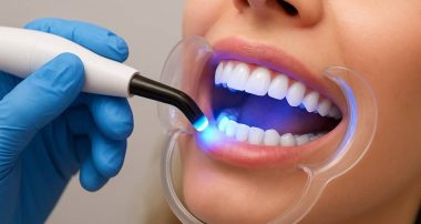 Відбілювання зубів